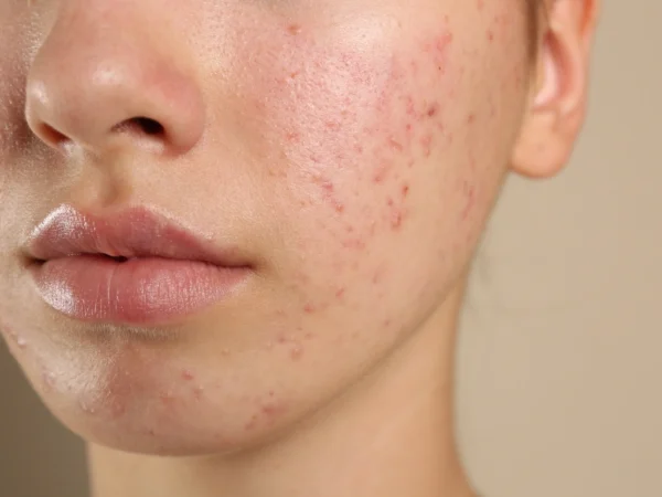 Close-up of a woman with rosacea