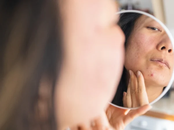Woman holding a round mirror to her face to examine a pimple