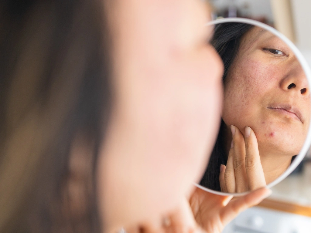 Woman holding a round mirror to her face to examine a pimple